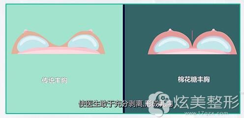 相比于传统丰胸充分剥离,假体展现更好,包膜挛缩减少 相比于传统丰胸充分剥离,假体展现更好,包膜挛缩减少