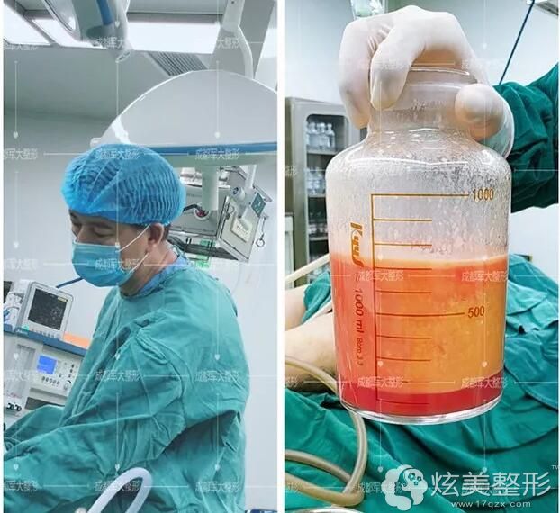 大腿抽脂3000ml是几斤有人瘦了6斤而我却瘦了8斤