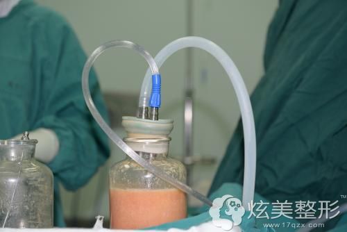 脂肪抽取的量 脂肪抽取的量