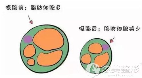 吸脂术后不会有反弹情况 吸脂术后不会有反弹情况