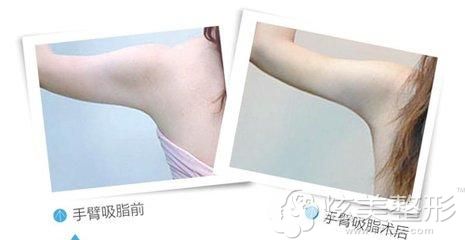 吸脂瘦胳膊效果对比 吸脂瘦胳膊效果对比