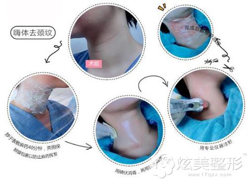 注射嗨体去颈纹的原理图 注射嗨体去颈纹的原理图