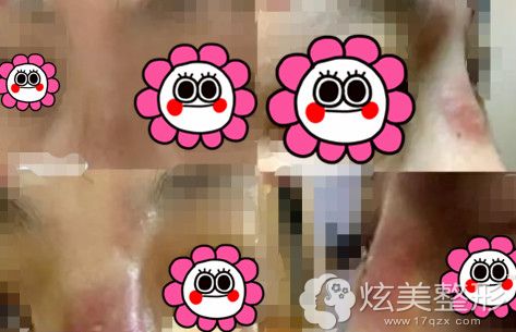 人工骨粉造成鼻子红肿发炎 人工骨粉造成鼻子红肿发炎