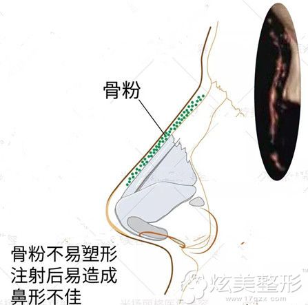 人工骨粉注射鼻子变形 人工骨粉注射鼻子变形