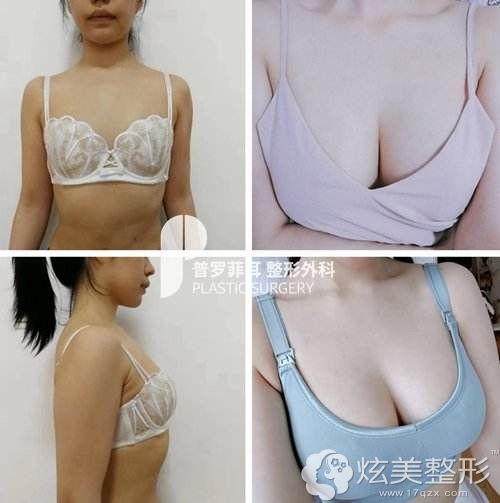 郑在皓院长隆胸案例 郑在皓院长隆胸案例