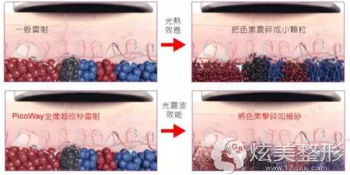超皮秒祛黄褐斑过程 超皮秒祛黄褐斑过程