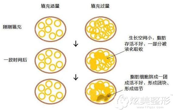 单次注射脂肪过多会引起硬结 单次注射脂肪过多会引起硬结