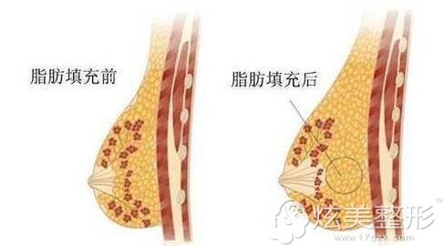 注射300cc能增大几个杯 注射300cc能增大几个杯