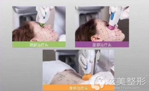 运用到不同部位的热玛吉探头 运用到不同部位的热玛吉探头