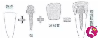 做完根管治疗后的牙齿是需要做牙冠的 做完根管治疗后的牙齿是需要做牙冠的