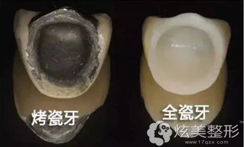 全瓷牙和烤瓷牙材质不同 全瓷牙和烤瓷牙材质不同