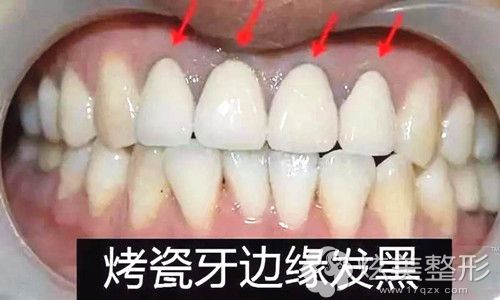 烤瓷牙很容易发黑 烤瓷牙很容易发黑