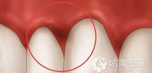 烤瓷牙容易对牙齿有损伤 烤瓷牙容易对牙齿有损伤