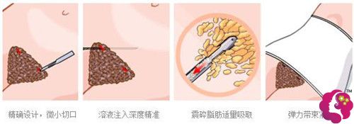 腰腹吸脂手术过程 腰腹吸脂手术过程