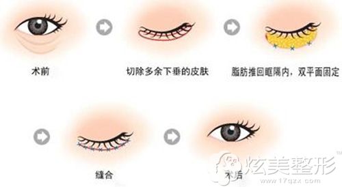 手术祛除眼袋的示意图 手术祛除眼袋的示意图