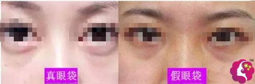 真性眼袋和假性眼袋的区别图 真性眼袋和假性眼袋的区别图