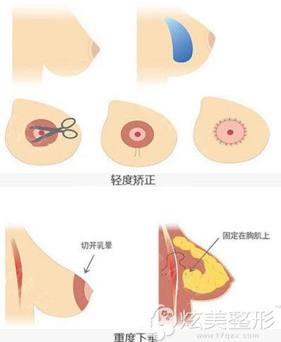 乳房悬吊术过程 乳房悬吊术过程
