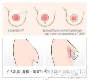 做乳房悬吊术同时植入假体效果更好 做乳房悬吊术同时植入假体效果更好