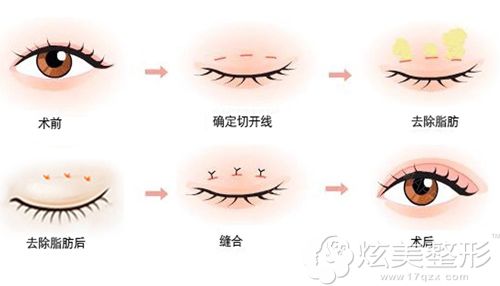姜院长做眼部综合整形示意图 姜院长做眼部综合整形示意图