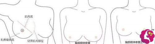 隆胸失败手术修复原理 隆胸失败手术修复原理