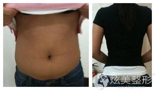 腰腹吸脂案例 腰腹吸脂案例