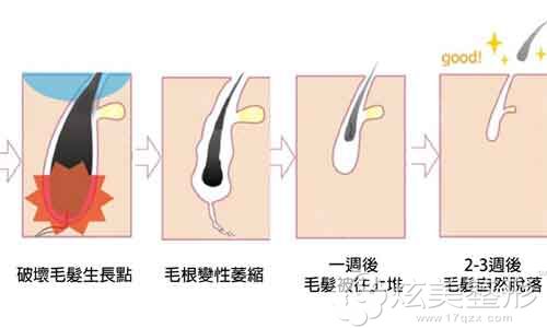 激光脱毛过程 激光脱毛过程