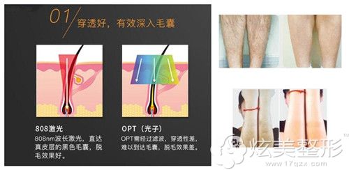 做激光脱毛术后效果对比 做激光脱毛术后效果对比