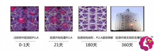 PLLA线做埋线提升能维持5-7年之久 PLLA线做埋线提升能维持5-7年之久