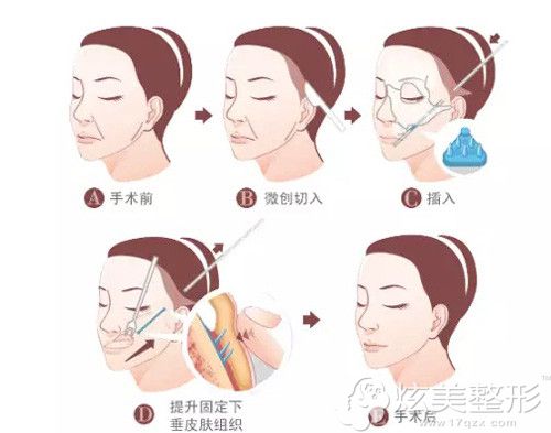小切口除皱手术的原理 小切口除皱手术的原理