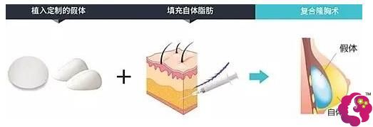 复合式丰胸手术原理 复合式丰胸手术原理