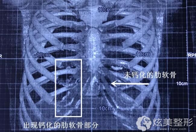 X光或CT肋骨三维重建诊断肋软骨是否出现钙化 X光或CT肋骨三维重建诊断肋软骨是否出现钙化