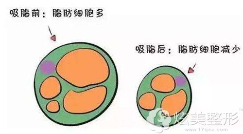 溶脂后脂肪细胞的一个变化 溶脂后脂肪细胞的一个变化