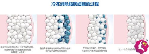 冷冻溶脂塑身的手术原理 冷冻溶脂塑身的手术原理