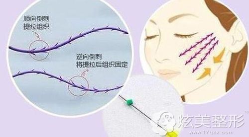 赵院长做埋线提升的手术原理 赵院长做埋线提升的手术原理