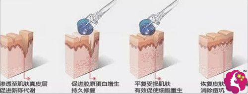 微针改善毛孔粗大 微针改善毛孔粗大