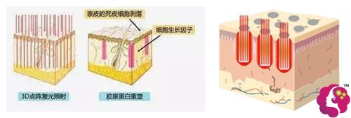 点阵激光缩毛孔 点阵激光缩毛孔