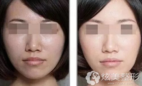 微针和点阵结合缩毛孔效果 微针和点阵结合缩毛孔效果