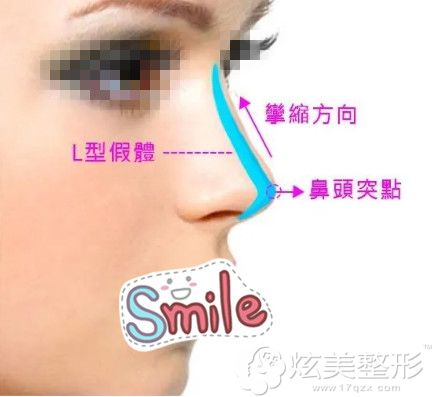 隆鼻假体取出后鼻子挛缩 隆鼻假体取出后鼻子挛缩