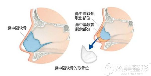 鼻中隔软骨修复朝天鼻 鼻中隔软骨修复朝天鼻
