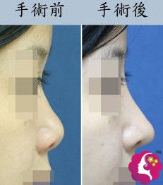 朝天鼻修复术后效果对比 朝天鼻修复术后效果对比