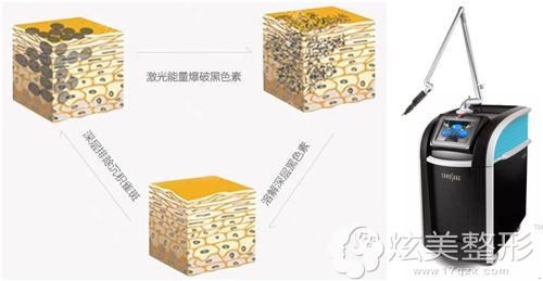 卢医生做皮秒激光祛斑手术原理 卢医生做皮秒激光祛斑手术原理