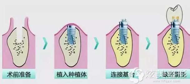 种植牙的手术过程图 种植牙的手术过程图