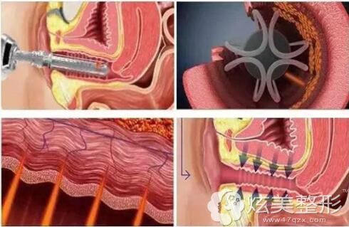 私密激光治疗的原理 私密激光治疗的原理