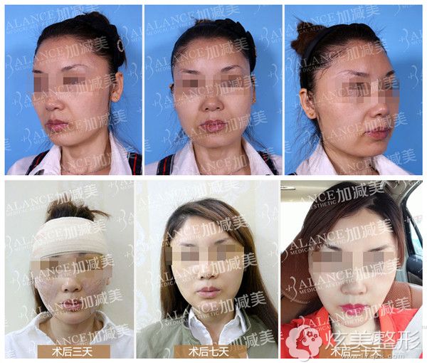 V美减龄之V3定格青春案例对比照 V美减龄之V3定格青春案例对比照