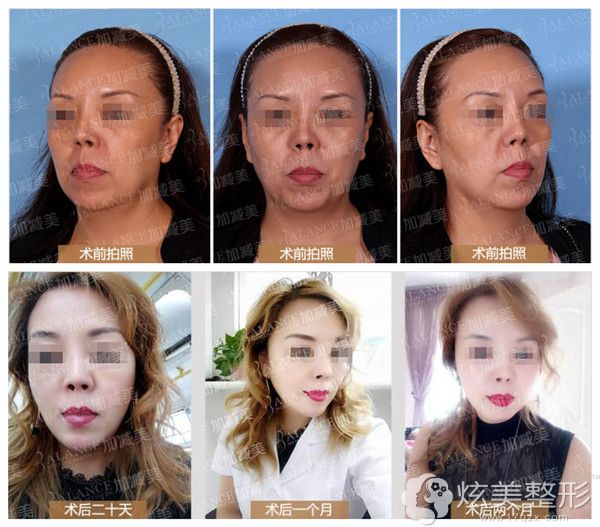 V美减龄之V6复位青春案例对比照 V美减龄之V6复位青春案例对比照