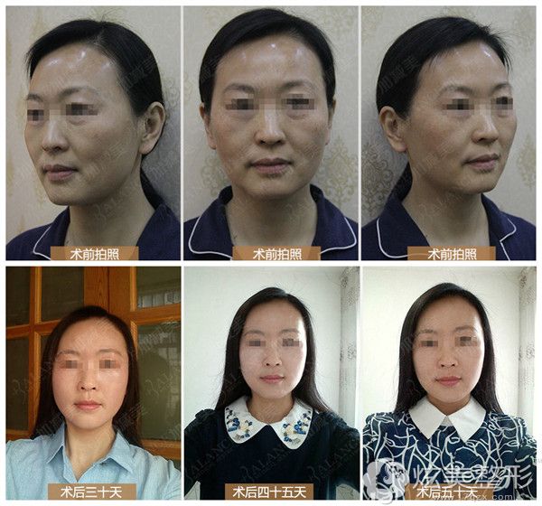 V美减龄之V9再生青春案例对比照 V美减龄之V9再生青春案例对比照