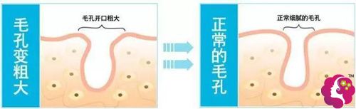 光子嫩肤治疗后出现毛孔变大 光子嫩肤治疗后出现毛孔变大