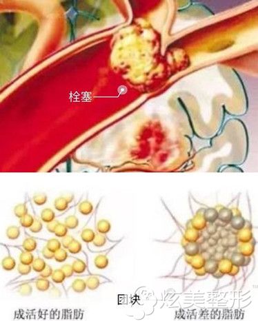 脂肪丰胸术后有硬结情况需要取出 脂肪丰胸术后有硬结情况需要取出