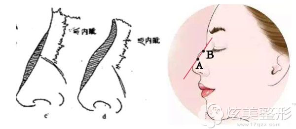 驼峰鼻较重要选择磨骨或者截骨术 驼峰鼻较重要选择磨骨或者截骨术