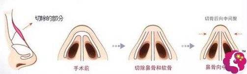 驼峰鼻矫正用截骨方法 驼峰鼻矫正用截骨方法